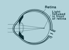 Das kurzsichtige Auge