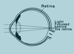 Das weitsichtige Auge